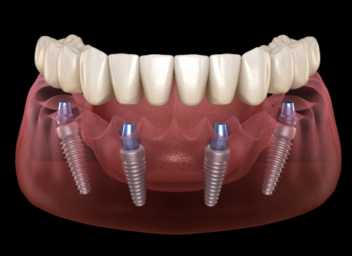 All-on-X Dental Implants
