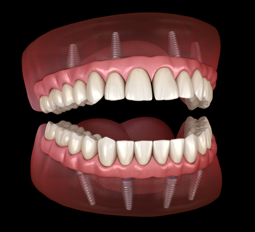 All-on-X Dental Implants treatment concept 